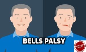 Bells Palsy