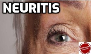 neuritis, Neuritis Symptoms, What is Neuritis, Types of Neuritis, Neuritis Causes